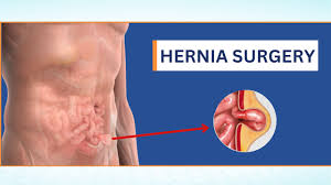 Hernioplasty Surgery