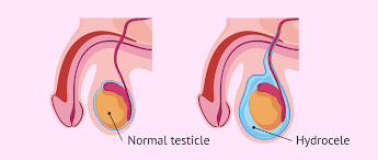 Hydrocele Surgery 